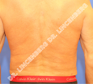 liposuction atlanta