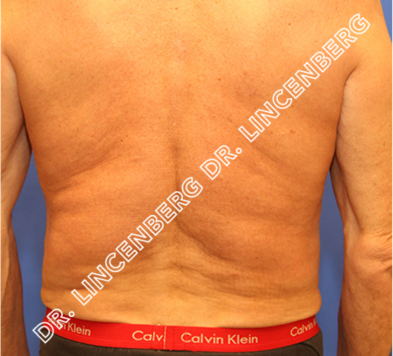 liposuction atlanta
