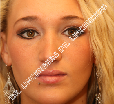 after rhinoplasty