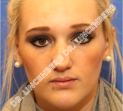 before rhinoplasty