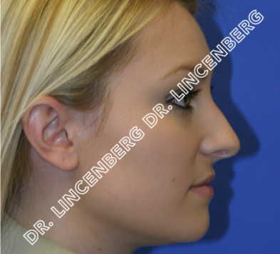 before rhinoplasty